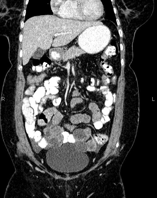 Bilateral ovarian serous cystadenocarcinoma (Radiopaedia 86062-101989 D 10).jpg