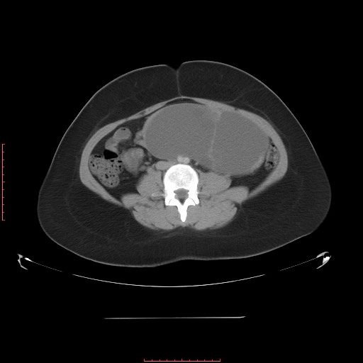 File:Bilateral ovarian serous cystadenocarcinoma with right ovarian torsion (Radiopaedia 32640-33611 A 24).jpg