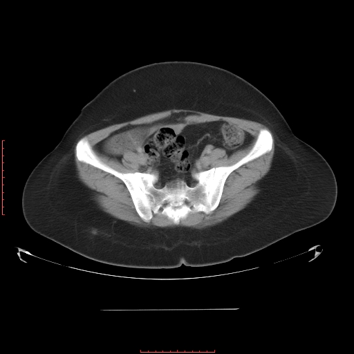 File:Bilateral ovarian serous cystadenocarcinoma with right ovarian torsion (Radiopaedia 32640-33611 A 33).jpg