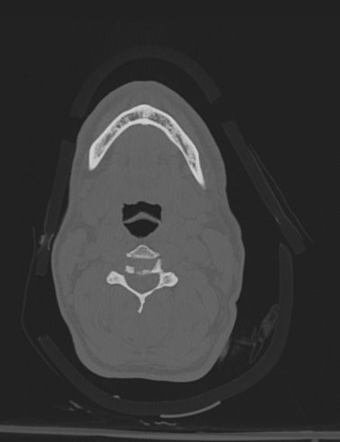 Bilateral perched facet joint (Radiopaedia 63149-71669 Axial bone window 24).jpg
