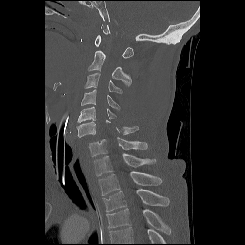 Bilateral perched facets with cord injury (Radiopaedia 45587-49713 Sagittal bone window 28).jpg