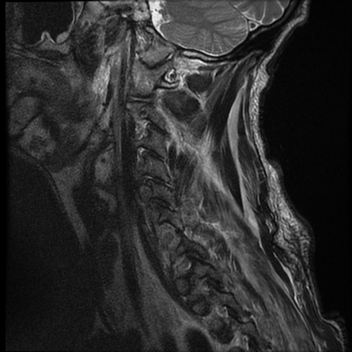 File:Bilateral perched facets with cord injury (Radiopaedia 45587-49714 Sagittal T2 1).jpg