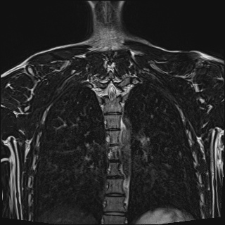Bilateral spinoglenoid notch ganglion cysts (Radiopaedia 29577-30082 Coronal T2 100).jpg
