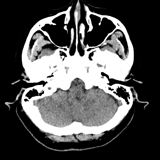 Bilateral subacute subdural hematoma (Radiopaedia 69240-79018 Axial non-contrast 9).jpg