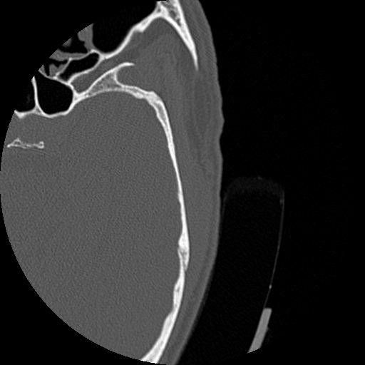 Bilateral temporal bone fractures (Radiopaedia 29482-29970 D 142).jpg