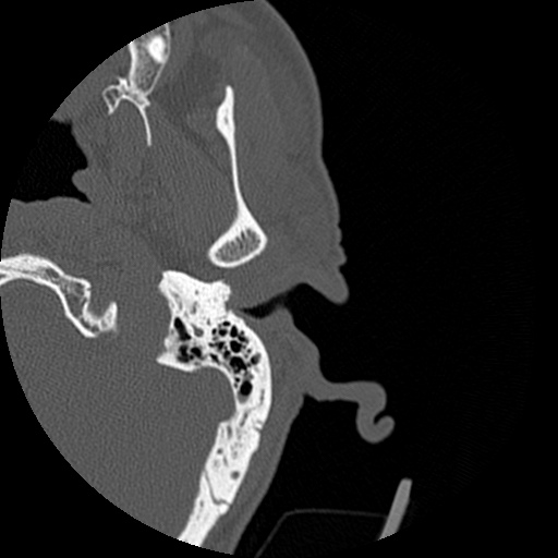 Bilateral temporal bone fractures (Radiopaedia 29482-29970 D 26).jpg