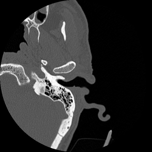 Bilateral temporal bone fractures (Radiopaedia 29482-29970 D 44).jpg