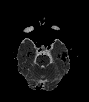 File:Bilateral thalamic glioma (Radiopaedia 65852-75009 Axial ADC 7).jpg