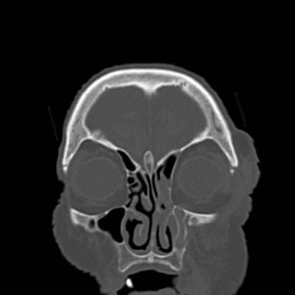 Biparietal osteodystrophy (Radiopaedia 46109-50463 Coronal bone window 22).jpg