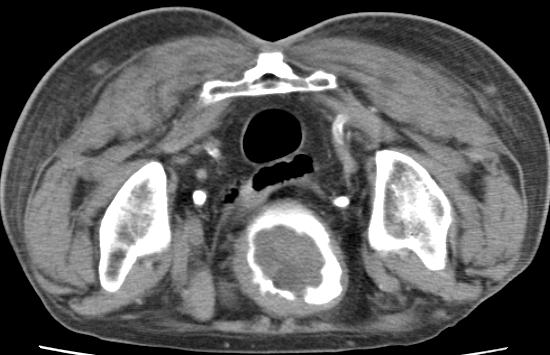 File:Bladder carcinoma (Radiopaedia 15813-15458 E 1).JPG