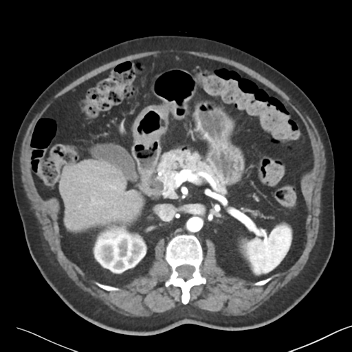 File:Bladder papillary urothelial carcinoma (Radiopaedia 48119-52951 A 16).png