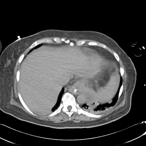 Bladder rupture post renal biopsy (Radiopaedia 30863-31572 Axial non-contrast 11).jpg