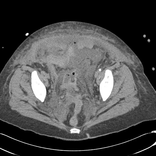 Bladder rupture post renal biopsy (Radiopaedia 30863-31572 Axial non-contrast 75).jpg