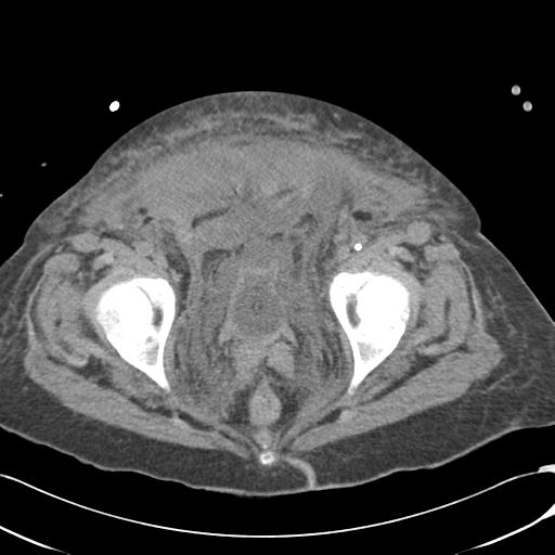 Bladder rupture post renal biopsy (Radiopaedia 30863-31572 Axial non-contrast 80).jpg