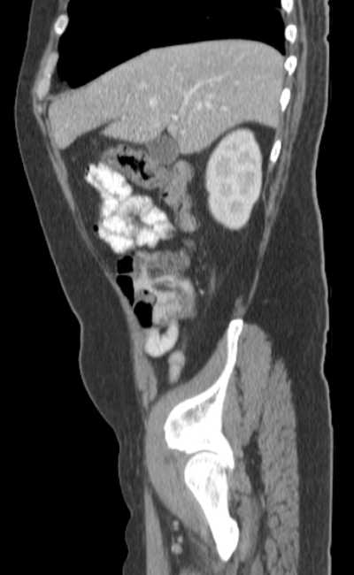 Bleeding duodenal ulcer and adenomyomatosis of gallbladder (Radiopaedia 61834-69861 C 22).jpg