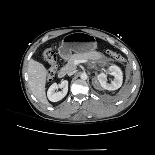 Blunt abdominal trauma with solid organ and musculoskelatal injury with active extravasation (Radiopaedia 68364-77895 A 48).jpg