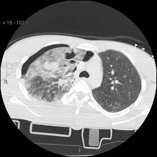 Blunt chest trauma (Swiss cheese sign) (Radiopaedia 38519-40618 Axial lung window 21).jpg