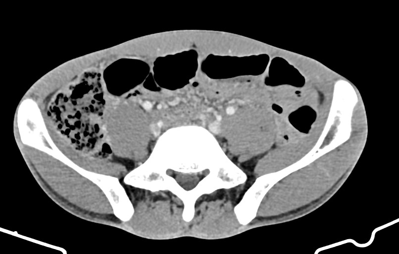 Blunt injury to the small bowel (Radiopaedia 74953-85987 A 133).jpg