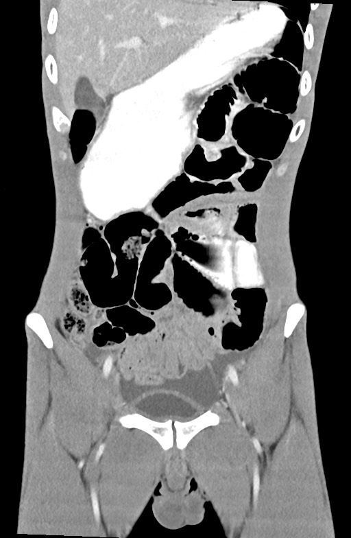 Blunt injury to the small bowel (Radiopaedia 74953-85987 B 30).jpg