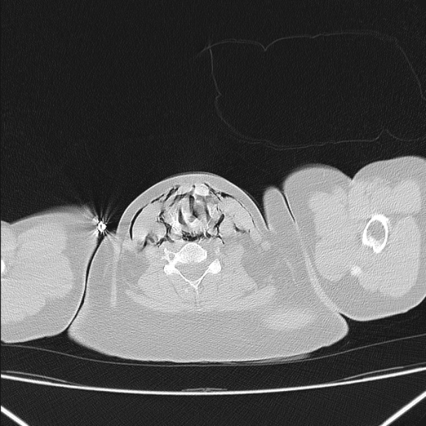 Boerhaave syndrome (Radiopaedia 45644-49799 Axial lung window 13).jpg