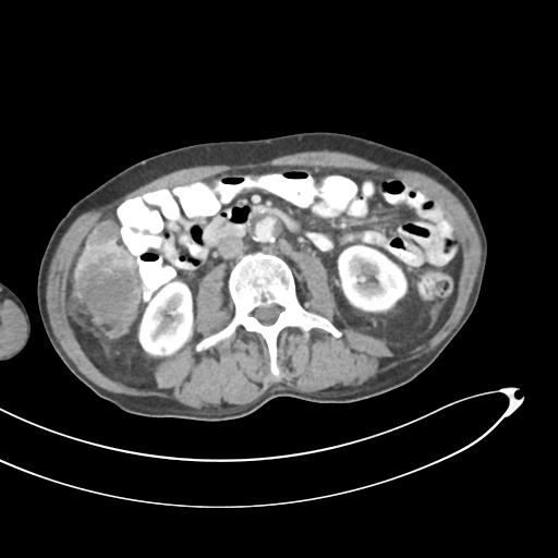 Bone metastasis from squamous cell carcinoma (Radiopaedia 30133-30730 B 36).jpg