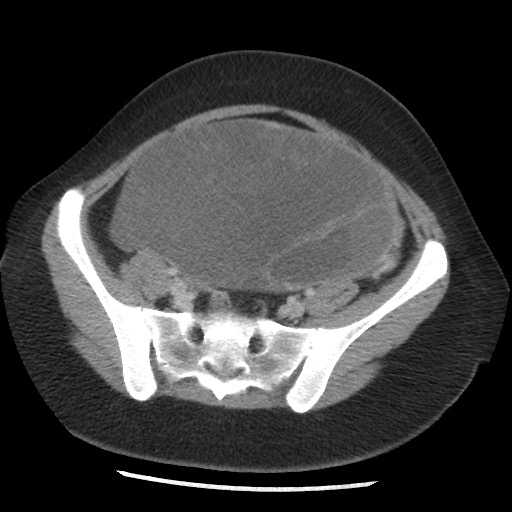 File:Borderline mucinous tumor (ovary) (Radiopaedia 78228-90808 A 115).jpg