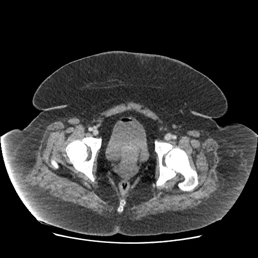 Bowel and splenic infarcts in acute lymphocytic leukemia (Radiopaedia 61055-68915 A 122).jpg