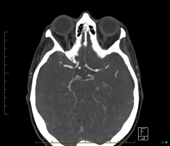 File:Brachiocephalic trunk stenosis (Radiopaedia 87242-103519 A 42).jpg