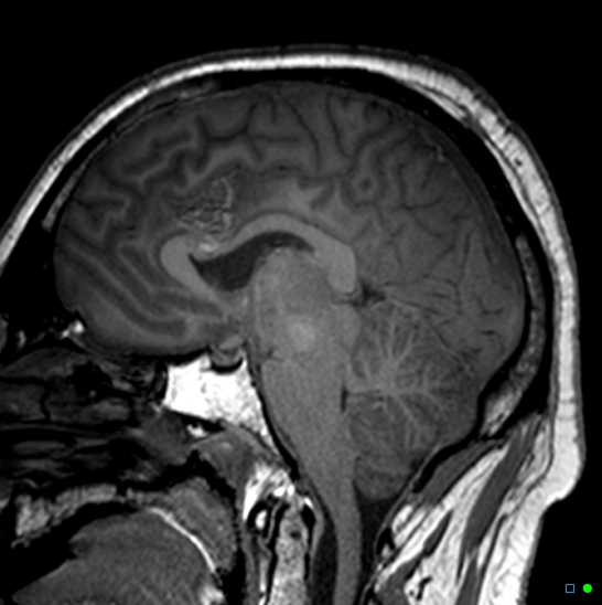 File:Brain death on MRI and CT angiography (Radiopaedia 42560-45689 Sagittal T1 22).jpg