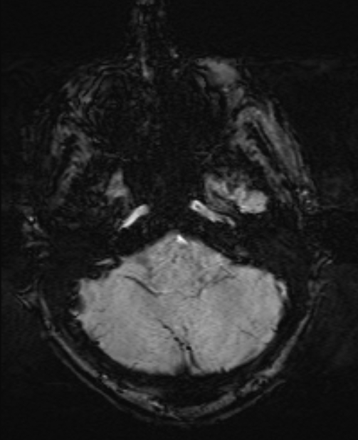 Brain metastases - lung cancer primary (Radiopaedia 75060-86115 Axial SWI 13).jpg