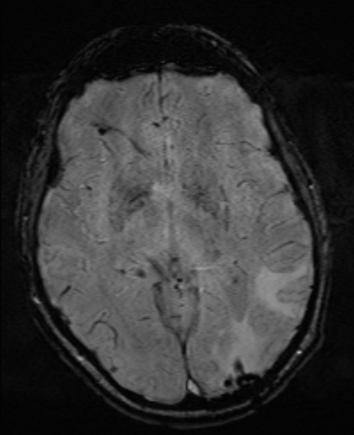 Brain metastases - lung cancer primary (Radiopaedia 75060-86115 Axial SWI 30).jpg