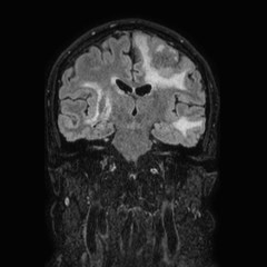 Brain metastases from lung cancer (Radiopaedia 83839-99028 Coronal FLAIR 42).jpg