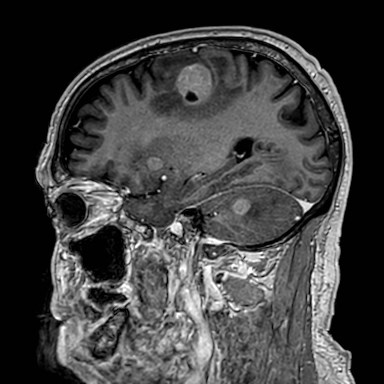 Brain metastases from lung cancer (Radiopaedia 83839-99028 Sagittal T1 C+ 44).jpg
