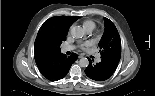 File:Brain metastases from squamocellular lung cancer (Radiopaedia 56515-63219 B 34).jpg