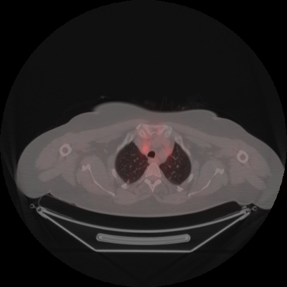 Brain metastasis (Radiopaedia 89847-106962 Axial lung window 8).jpg
