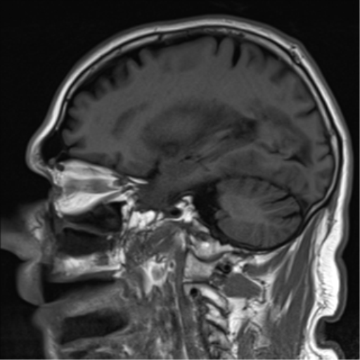 File:Brain metastasis (large cystic mass) (Radiopaedia 47497-52107 Sagittal T1 11).png