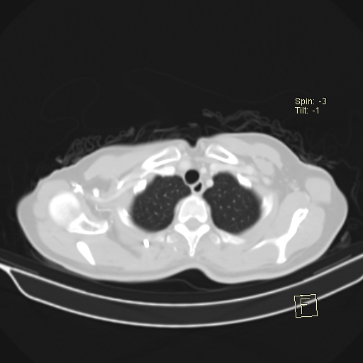 Brain metastasis as initial presentation of non-small cell lung cancer (Radiopaedia 65122-74127 Axial lung window 7).jpg