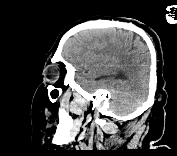 Brainstem hemorrhage (Radiopaedia 81294-94976 C 43).jpg