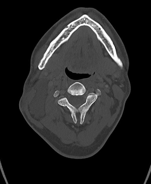 Branchial cleft cyst (Radiopaedia 31167-31875 Axial bone window 28).jpg