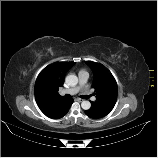 Breast cancer on thorax CT (Radiopaedia 60571-68275 A 45).JPG