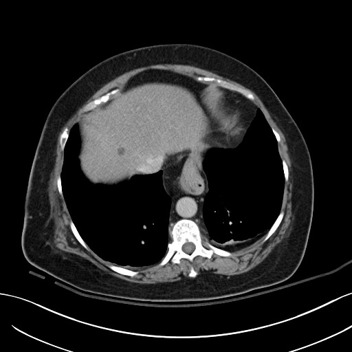 Breast carcinoma with pathological hip fracture (Radiopaedia 60314-67974 B 8).jpg