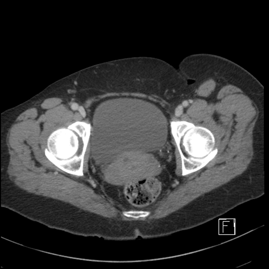 File:Breast metastases from renal cell cancer (Radiopaedia 79220-92225 C 112).jpg