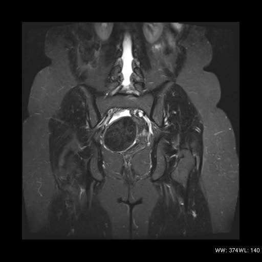 File:Broad ligament fibroid (Radiopaedia 49135-54241 Coronal STIR 18).jpg