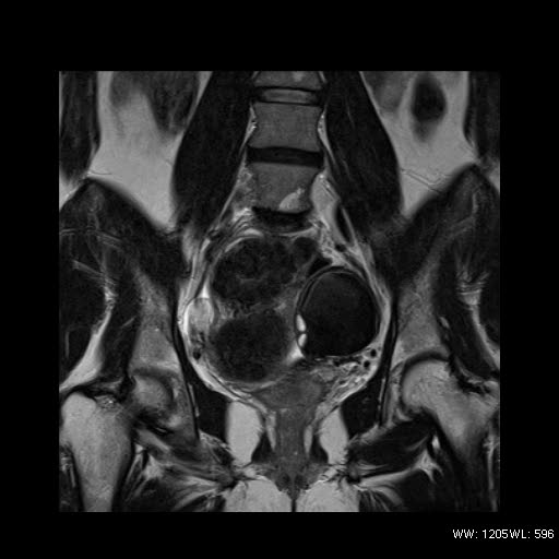 File:Broad ligament fibroid (Radiopaedia 49135-54241 Coronal T2 15).jpg
