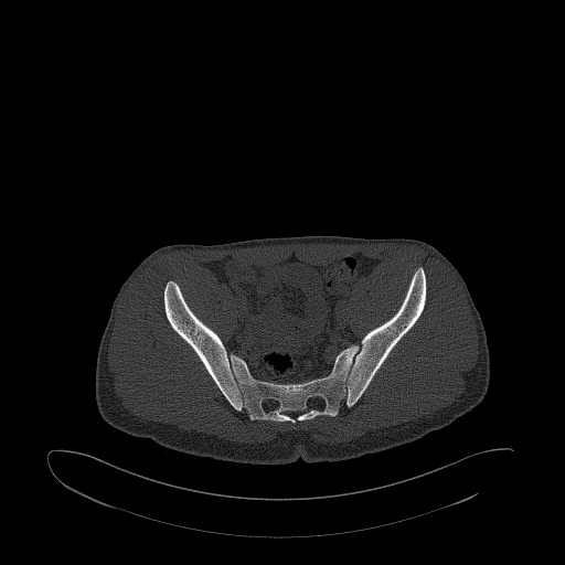 Brodie abscess- femoral neck (Radiopaedia 53862-59966 Axial bone window 76).jpg