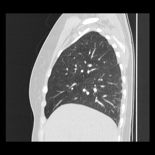 Bronchial atresia (Radiopaedia 22965-22992 Sagittal lung window 40).jpg