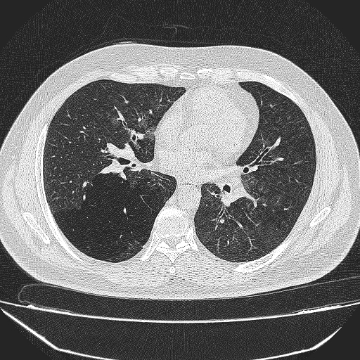 File:Bronchial atresia (Radiopaedia 58271-65417 Axial lung window 26).jpg