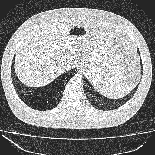 File:Bronchial atresia (Radiopaedia 58271-65417 Axial lung window 44).jpg