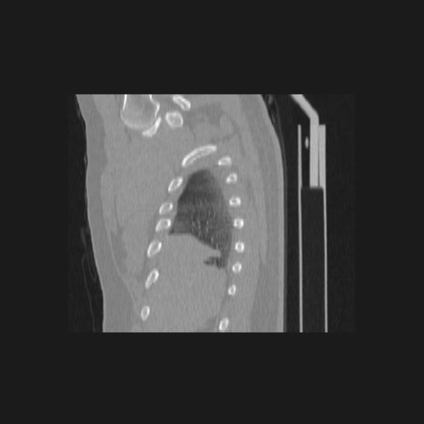 Bronchial atresia (Radiopaedia 60685-68439 Sagittal lung window 6).jpg