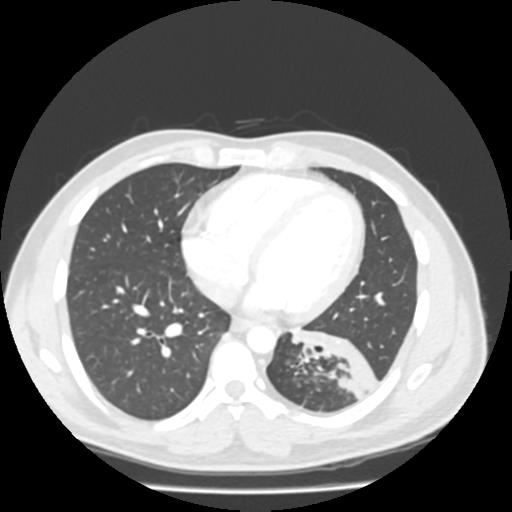 Bronchial carcinoid (Radiopaedia 80013-93291 Axial lung window 82).jpg